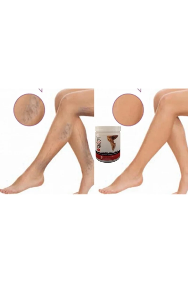 Varison Var.is Sellulit Bacak Bakım Kremi 200 ml