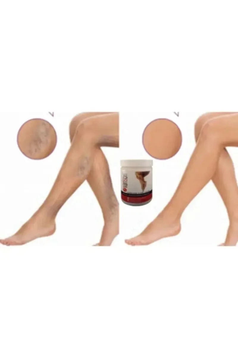 Kremi 200ML / Varison Varicose Veins Cream 200ML X 3 ADET